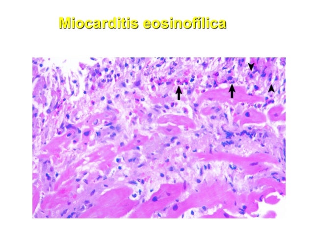 Miocarditis Una Revision