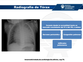 Radiografía de Tórax
Corazón desde la normalidad hasta un
marcado crecimiento del VI ó del VD, o ambos
Derrame pericárdico
Infiltrados
pulmonares
Congestión pulmonar
braunwald.tratado.de.cardiologia.9a.edicion, cap.70.
 