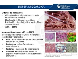 BIOPSIA MIOCARDICA
Criterios de dallas 1986
• Infiltrado celular inflamatorio con o sin
necrosis de los miocitos
• Clasificación infiltrado: severidad,
distribución , tipo (linfocitico, eosinofilico,
granulomatoso)
• S59% - E89%
Inmunohistoquímica: s 69 - e 100%
Identifica poblaciones celulares mejorando
sensibilidad y pronostico
• Viral : infiltrado monunucear CD3 o CD68
mas de 14 cel /mm3
• Bacteriano: polimofonucleares,
microabscesos
• Parásitos : evidencia del tripanosoma
• Autoinmune: miocarditis de células
gigantes multinucleadas en ausencia de
granulomas
 
