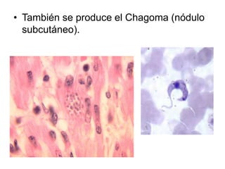 • También se produce el Chagoma (nódulo
subcutáneo).
 