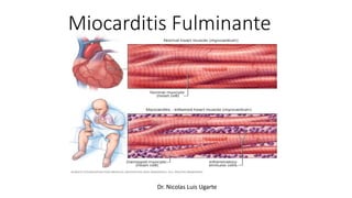 Miocarditis Fulminante
Dr. Nicolas Luis Ugarte
 