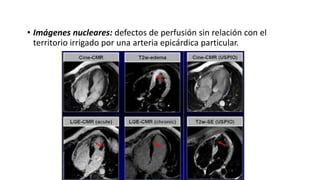 • Imágenes nucleares: defectos de perfusión sin relación con el
territorio irrigado por una arteria epicárdica particular.
 