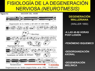 FISIOLOGÍA DE LA DEGENERACIÓN
    NERVIOSA (NEUROTMESIS)
                           DEGENERACIÓN
                            WALLERIANA
                             (WALLER 1850)


                         •A LAS 48-96 HORAS
                         POST-LESIÓN


                         •FENÓMENO ISQUEMICO


                         •DESORGANIZACIÓN
                         AXONAL


                         •DEGENERACIÓN
              1 mm/día   MIELÍNICA
 
