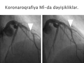 Miokard infarkti (Myocardia infarctus)