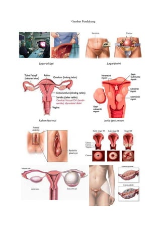 Gambar Pendukung 
Laparoskopi Laparatomi 
Rahim Normal Jenis-jenis miom 
