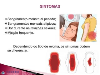 Sangramento menstrual pesado;
Sangramentos mensais atípicos;
Dor durante as relações sexuais;
Micção frequente.
Dependendo do tipo de mioma, os sintomas podem
se diferenciar:
 