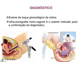 Exame de toque ginecológico de rotina;
Ultra-sonografia trans-vaginal é o exame indicado para
a confirmação do diagnóstico.
 