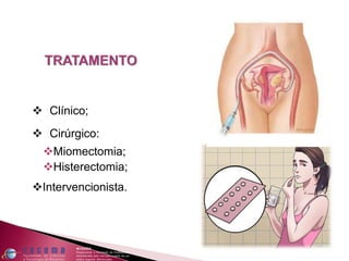  Clínico;
 Cirúrgico:
Miomectomia;
Histerectomia;
Intervencionista.
 
