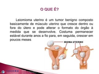 Leiomioma uterino é um tumor benigno composto
basicamente de músculo uterino que cresce dentro ou
fora do útero e pode alterar o formato do órgão à
medida que se desenvolve. Costuma permanecer
estável durante anos a fio para, em seguida, crescer em
poucos meses
 
