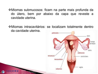 Miomas submucosos: ficam na parte mais profunda da
do útero, bem por abaixo da capa que reveste a
cavidade uterina.
Miomas intracavitários: se localizam totalmente dentro
da cavidade uterina.
 