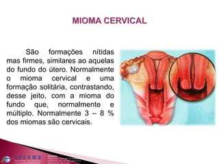 São formações nítidas
mas firmes, similares ao aquelas
do fundo do útero. Normalmente
o mioma cervical e uma
formação solitária, contrastando,
desse jeito, com a mioma do
fundo que, normalmente e
múltiplo. Normalmente 3 – 8 %
dos miomas são cervicais.
 