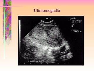 Ultrasonografía 