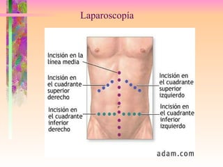Laparoscopía 
