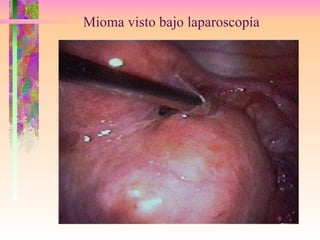Mioma visto bajo laparoscopía 