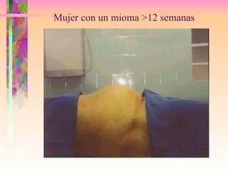 Mujer con un mioma >12 semanas 