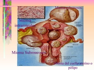 Mioma subserosos   Mioma del cuello uterino o pólipo Mioma Submucosos Mioma intramurales 