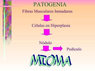 Fibras Musculares Inmaduras Células en Hiperplasia Nódulo Pedículo MIOMA PATOGENIA 