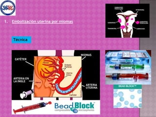 Diámetro del mioma.