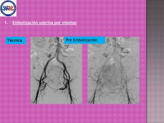 Mioma pedunculado.Embolización uterina por miomasTécnica