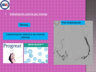 Embolización uterina por miomasTécnicaCateterización selectiva de arterias uterinasPre Embolización