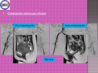 Embolización uterina por miomasPost EmbolizaciónTécnicaCateterización selectiva de arterias uterinas