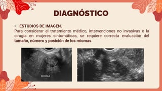 DIAGNÓSTICO
• ESTUDIOS DE IMAGEN.
Para considerar el tratamiento médico, intervenciones no invasivas o la
cirugía en mujeres sintomáticas, se requiere correcta evaluación del
tamaño, número y posición de los miomas.
 