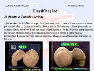 Ac. Bruna Pimentel de Jesus  Miomatose Uterina Classificação: 3) Quanto à Camada Uterina: Subseroso :  Se localiza na superfície do útero, entre o miométrio e o revestimento peritoneal; abaixo da serosa uterina. Tem mais de 50% de seu volume projetado na camada serosa do útero. Pode ser séssil ou pediculado.  Pode ter como complicações mecânicas principalmente nos pediculados: torção, necrose e hemorragias peritoneais. É o que provoca  menos sintomas . Diagnóstico diferencial: Tumores do Ovário. 