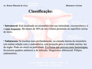 Classificação: Ac. Bruna Pimentel de Jesus  Miomatose Uterina Intramural:  Está localizado no miométrio (em sua intimidade, ciscunscritos) e é o  mais frequente . Há menos de 50% de seu volume protuindo na superfície serosa do útero. Submucoso:  Se localiza mais profundamente, na camada interna do miométrio (em íntima relação com o endométrio), com projeção para a cavidade uterina, luz do órgão. Pode ser séssil ou pediculado.  É a forma que provoca mais hemorragias,  favorecem quadros anêmicos e de infecção. Diagnóstico diferencial: Pólipos endometriais.  