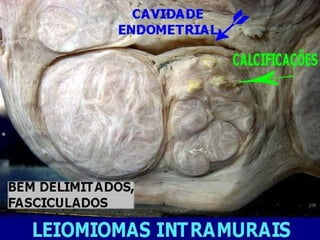 Ac. Bruna Pimentel de Jesus  Miomatose Uterina                                                         