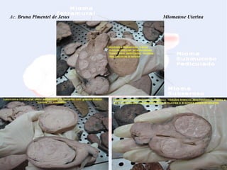 Ac.  Bruna Pimentel de Jesus  Miomatose Uterina 