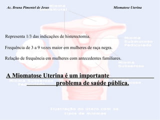 Ac. Bruna Pimentel de Jesus  Miomatose Uterina Representa 1/3 das indicações de histerectomia. Frequência de 3 a 9 vezes maior em mulheres de raça negra. Relação de frequência em mulheres com antecedentes familiares. A Miomatose Uterina é um importante  problema de saúde pública. 