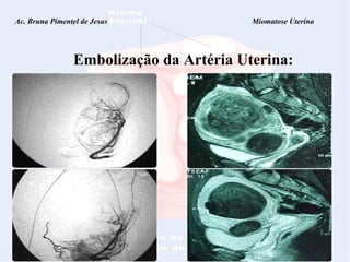 Ac. Bruna Pimentel de Jesus  Miomatose Uterina Embolização da Artéria Uterina: 