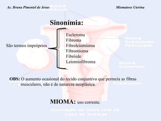 Ac. Bruna Pimentel de Jesus  Miomatose Uterina Sinonímia:   Escleroma   Fibroma São termos impróprios Fibroleiomioma  Fibromioma     Fibróide   Leiomiofibroma OBS:  O aumento ocasional do tecido conjuntivo que permeia as fibras musculares, não é de natureza neoplásica. MIOMA:   uso corrente. 
