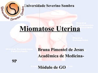   Universidade Severino Sombra         Miomatose Uterina Bruna Pimentel de Jesus Acadêmica de Medicina- 9P Módulo de GO 