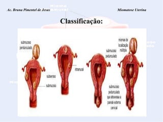 Classificação: Ac. Bruna Pimentel de Jesus  Miomatose Uterina 