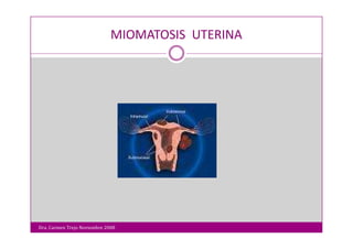 Miomatosis Uterina
