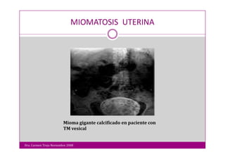 Miomatosis Uterina