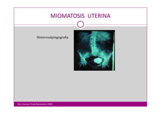 Miomatosis Uterina