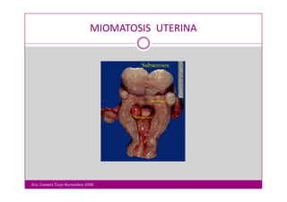 Miomatosis Uterina