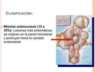 CLASIFICACIÓN:
 Miomas submucosos (15 a
25%): Lesiones más sintomáticas;
se originan en la pared miometrial
y protruyen hacia la cavidad
endometrial.
 