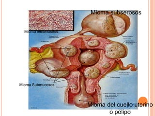 Mioma subserosos
Mioma del cuello uterino
o pólipo
Mioma Submucosos
Mioma intramurales
 