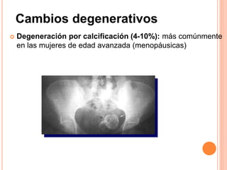  Degeneración por calcificación (4-10%): más comúnmente
en las mujeres de edad avanzada (menopáusicas)
Cambios degenerativos
 