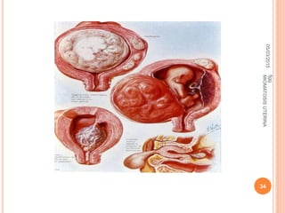 05/03/2015
fjgg
MIOMATOSISUTERINA
34
 