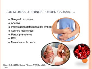  Sangrado excesivo
 Anemia
 Implantación defectuosa del embrión
 Abortos recurrentes
 Partos prematuros
 RCIU
 Molestias en la pelvis
LOS MIOMAS UTERINOS PUEDEN CAUSAR….
Bulun, S. E. (2013). Uterine Fibroids. N ENG J MED ,
1344.
 