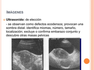 IMÁGENES
 Ultrasonido: de elección
- se observan como defectos ecodensos; provocan una
sombra distal. identifica miomas, número, tamaño,
localización; excluye o confirma embarazo conjunto y
descubre otras masas pelvicas
 