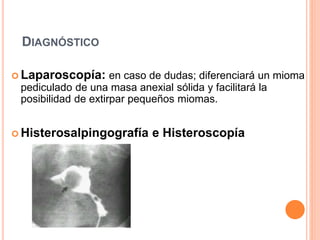 DIAGNÓSTICO
 Laparoscopía: en caso de dudas; diferenciará un mioma
pediculado de una masa anexial sólida y facilitará la
posibilidad de extirpar pequeños miomas.
 Histerosalpingografía e Histeroscopía
 