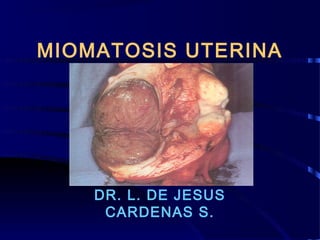 MIOMATOSIS UTERINA

DR. L. DE JESUS
CARDENAS S.

 