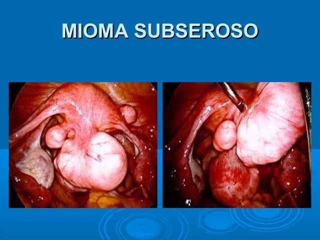 Tipos de Mioma | mioma Subseroso, Mioma Intramural e mioma