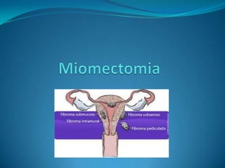 Miomectomia