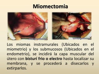 MiomectomiaLos miomas instramurales (Ubicados en el miometrio) y los submucosos (Ubicados en el endometrio), se incidirá la capa muscular del útero con bisturí frio o electro hasta localizar su membrana, y se procederá a disecarlos y extirparlos.
